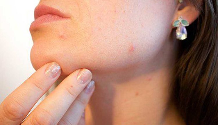 Get Rid of Annoying Pimples