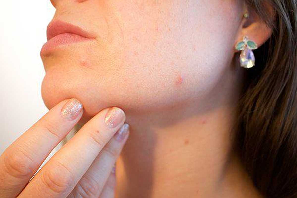 Get Rid of Annoying Pimples