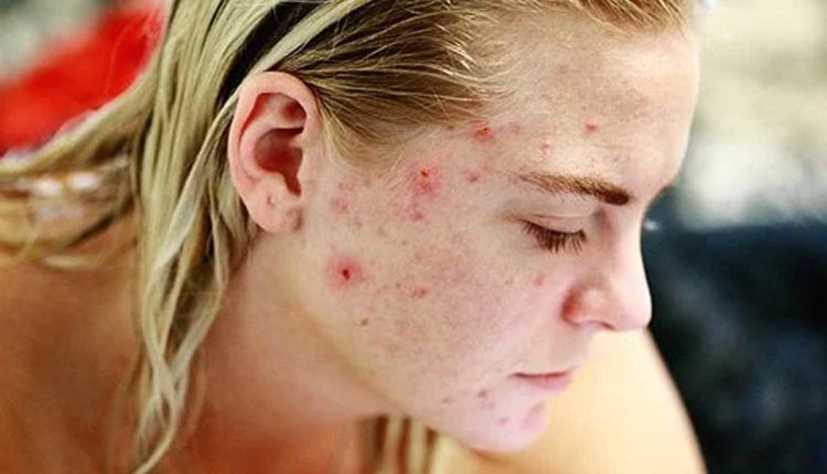 Acne and Self Esteem