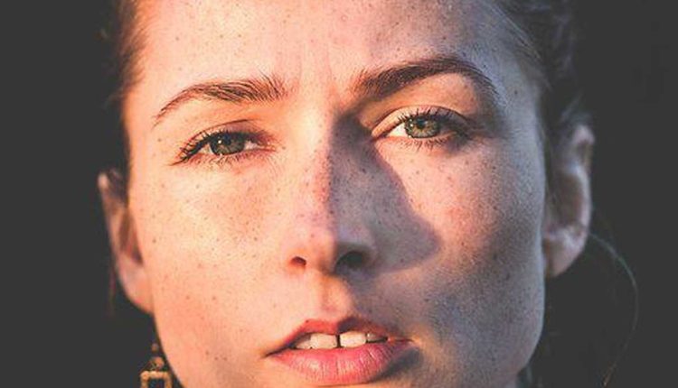Skin Discoloration